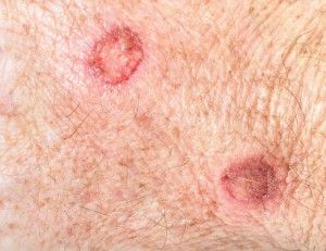 5 Warning Signs of Basal Cell Carcinoma Tes, Basil Cell Carcinoma, Basal Cell, Skin Bumps, Squamous Cell, Skin Disorders, Dermatology, Warning Signs, Skin Health