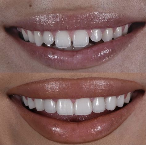 Teeth Correction, Perfect Skin Routine, Fix Teeth, Teeth Aesthetic, Cosmetic Dentistry Procedures, Dental Posts, Veneers Teeth, Aesthetic Dentistry, Beautiful Teeth