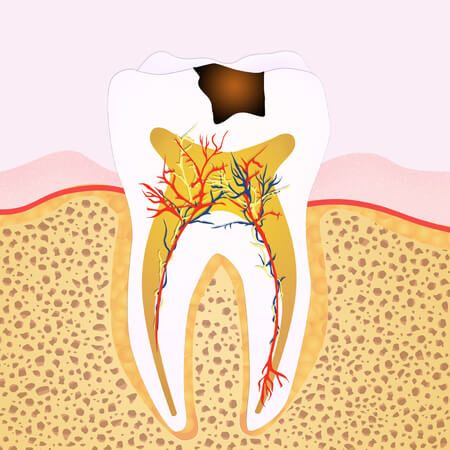 Impacted Wisdom Teeth, Tooth Nerve, Tooth Extraction Healing, Cracked Tooth, Tooth Infection, Sensitive Teeth Remedy, Remedies For Tooth Ache, Dental Surgeon, Loose Tooth