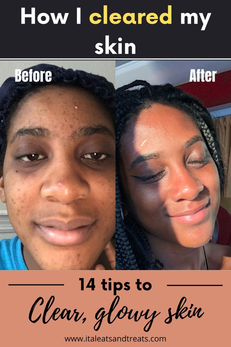 Acne Clearing Products, Best Skin Clearing Products, Teenage Acne Skincare Routine Homemade, How To Get Rid Of Face Acne, How To Make My Face Clear, Acne Removal Face Mask, Recipes For Acne Clear Skin, Acne Safe Recipes, Tea For Acne Clear Skin