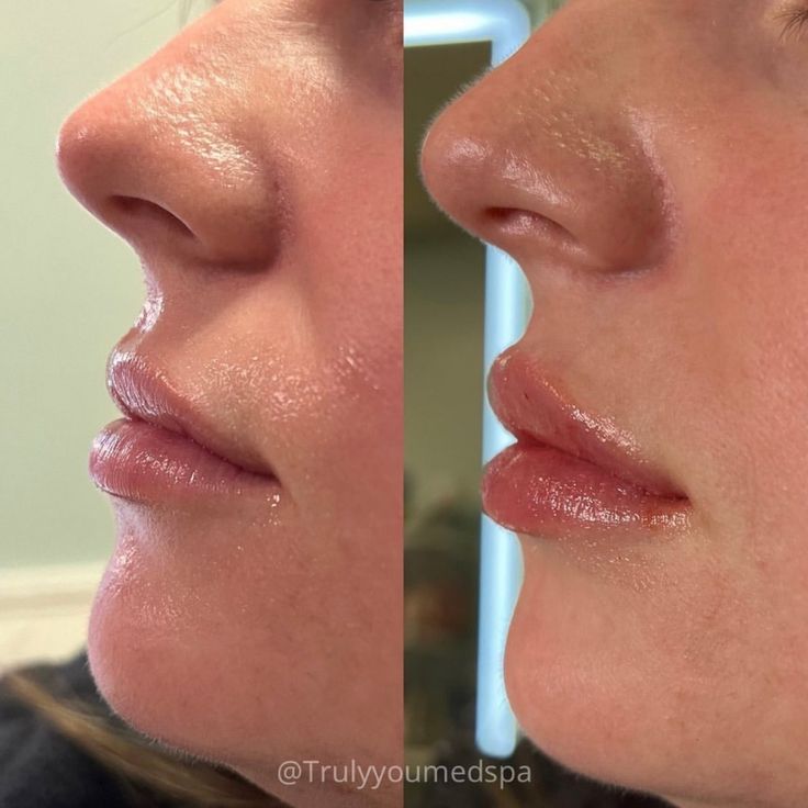 Lip fillers aren’t just about volume—they’re KEY to facial balancing ✨ Subtle enhancements can create harmony and symmetry, boosting your overall appearance. Check out these before and after photos and get tips on how to care for your lips post-appointment! - - - - 👨🏻‍⚕️@seanmoore_toscamoore 👨🏻‍⚕️@dr.getsnatched 👩🏼‍⚕️@elevated_beautybysamiah 👩🏼‍⚕️@tylatheesty 👩🏼‍⚕️@colbytheaesthetician ____________________ BOOK WITH US ⬇ 🌐 Online Booking -link in bio 📲 (386) 438-8687 📍Lake City, Florida 🖥️ ... Flat Lips Filler, Lip Filler Side Profile, Lip Flip Before And After, Lip Fillers Before And After, Subtle Lip Filler, Lip Filler Before And After, Facial Balancing, Facial Symmetry, Lip Flip