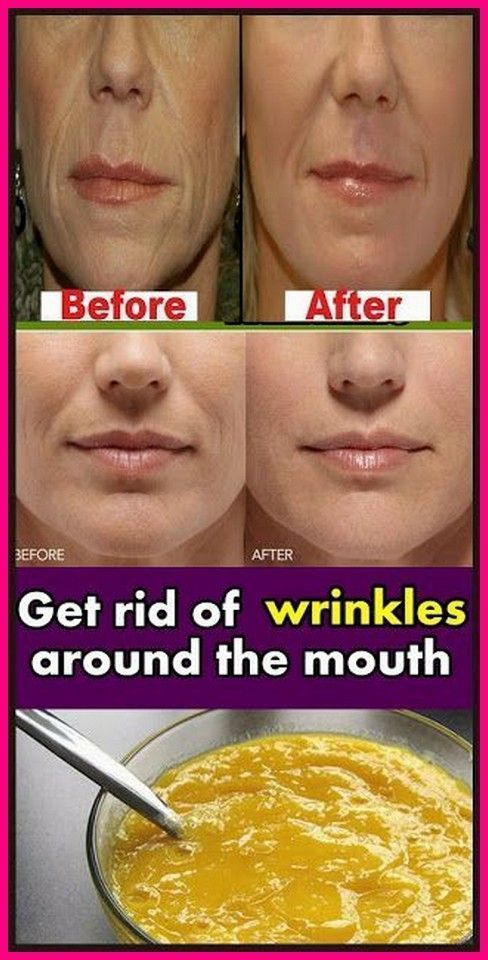 Mouth Wrinkles, Get Rid Of Wrinkles, Wrinkle Remedies, Skin Care Routine For 20s, Skin Care Wrinkles, Baking Soda Shampoo, Face Wrinkles, Wrinkled Skin, Unwanted Hair Removal