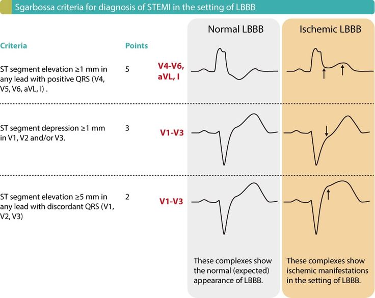 Figure 1. ECG criteria (Sgarbossa criteria) for acute STEMI in the setting of LBBB. Each criteria gives 2 to 5 points. Studies show that a cut-off of ≥3 points yields a sensitivity of 20–36% and specificity of 90–98% for acute STEMI in the setting of LBBB. Left Bundle Branch Block, Troponin Levels, Bundle Branch Block, St Elevation, Ekg Interpretation, Cardiogenic Shock, Paramedic School, Acute Coronary Syndrome, Medical Library