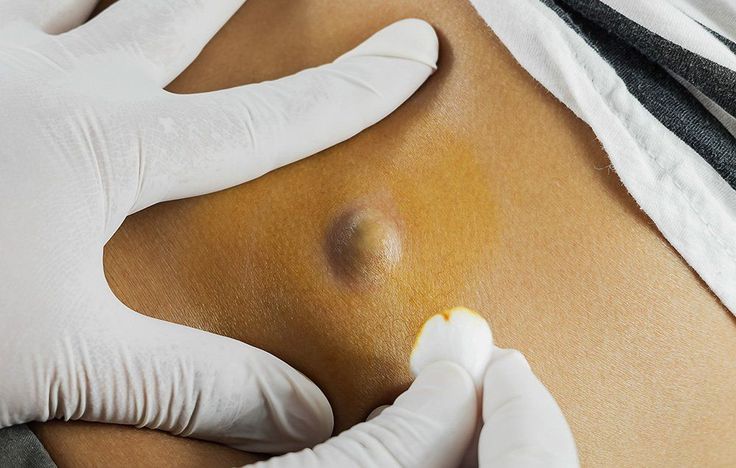 What It’s REALLY Like To Have A 10-Year-Old Cyst Removed Huge Pimple, Big Pimple, Cystic Pimple, Pimples Under The Skin, Zits Popping, Cystic Acne, Skin Disorders, Unwanted Hair Removal, Unwanted Hair