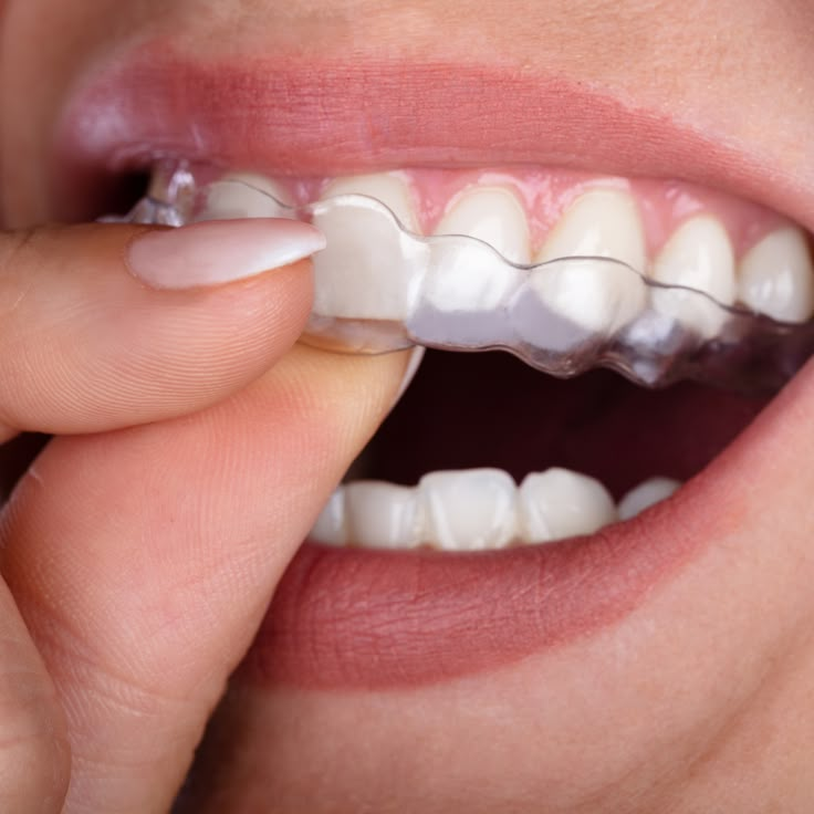 Invisible Teeth Braces, Teeth Aligners, Invisalign Aligners, Teeth Alignment, Remedies For Tooth Ache, Traditional Braces, Invisible Braces, Clear Braces, Clear Aligners