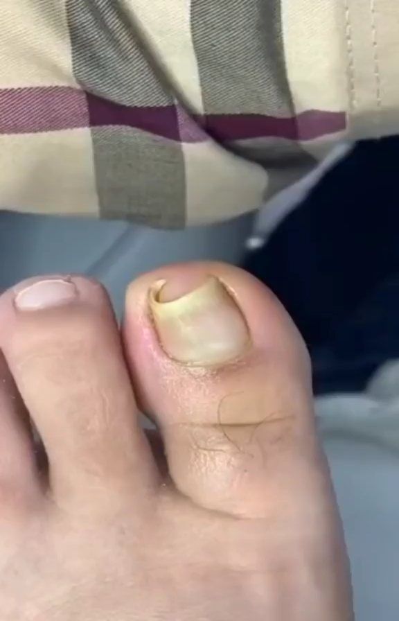 Toe Nail Cleaning, Ingrowing Toenail, Ingrown Nail Removal, Toenail Health, Infected Toenail, Toenail Removal, Nail Problems, Ingrown Toenail, Cleaning Videos