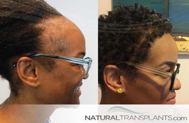 Traction Alopecia Tuesday - Female hair transplant before and after images weekly. Contact us today at 844-327-4247 or +1 954-372-8824 to learn more.  .  .  .  .  #tractionalopeciatuesday #tractionalopecia #tuesday #tuesdaymotivation #tuesdays #tuesdaythoughts #tuesdaytip #hairtransplant #hairrestoration #hairdoctor #hairloss #naturalhairtransplants #naturaltransplants Female Hair Transplant, Hair Growth Methods, Hair Transplant Women, Traction Alopecia, Hair Transplant Results, Aesthetic Dermatology, Hair Doctor, Female Hair, Lip Fillers