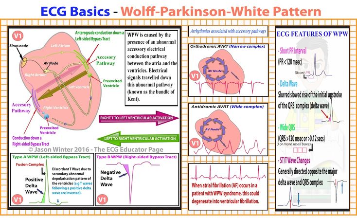 ECG Basics - Ventricular Rhythms #Cardiology #MedStudent #EKG #Ventricular #VentricularRhythms #Comparison #Table Wolff Parkinson White Syndrome, Nurse Practitioner School, Cardiac Rhythms, Nursing Assessment, Nursing School Studying, Medical School Studying, Emergency Nursing, Medicine Book, Nursing Education