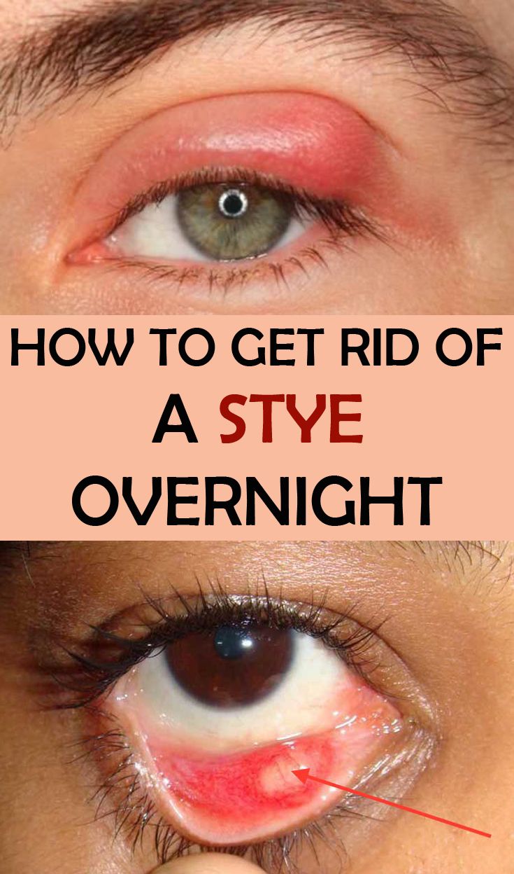 Learn how to get rid of a stye overnight. Homemade Antibiotics, Stye Remedies, Stye Remedy, Giant Scrabble, Overnight Remedies, Eye Stye Remedies, Eye Infections, Overnight Beauty, Outfit Yoga