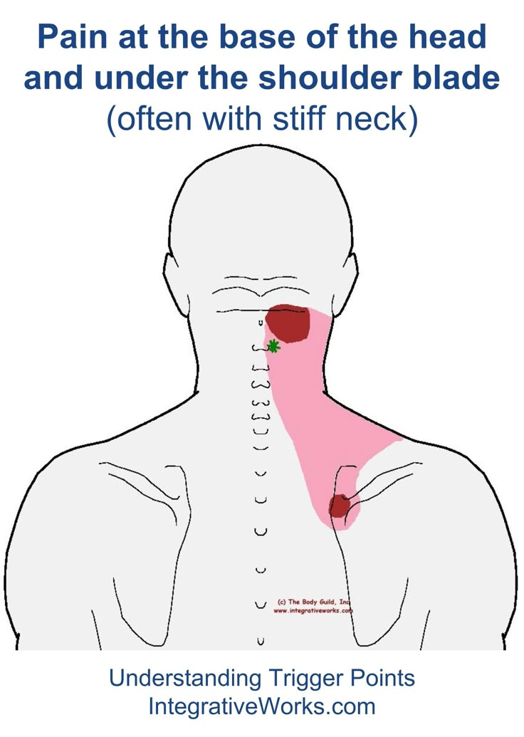 Understanding Trigger Points - Pain at the Base of the Head and Under Shoulder Blade Punkty Spustowe, Excellent Health, Neck Exercises, Stiff Neck, Upper Back Pain, Trigger Point, Neck And Shoulder Pain, Headache Relief, Trigger Points