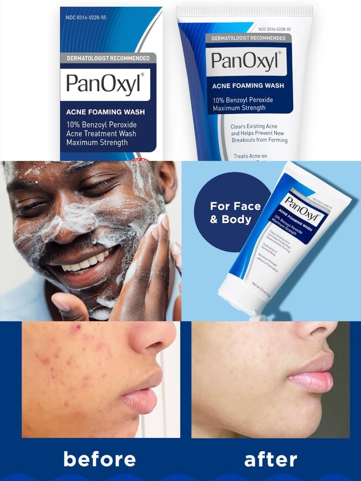 PanOxyl Acne Foaming Wash Benzoyl Peroxide 10% Maximum Strength Antimicrobial, 5.5 Oz Panoxyl Acne Foaming Wash, Benzoyl Peroxide, Face Acne, Dermatologist Recommended, How To Treat Acne, Beauty Product, Skincare Products, Beauty And Personal Care, Acne