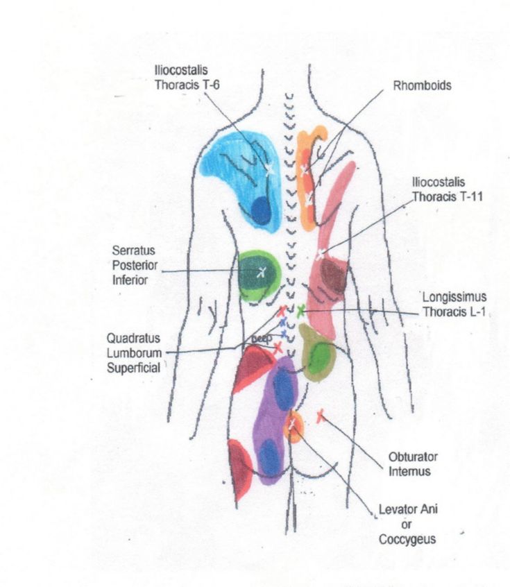 Muscle Testing Point | Muscle Attachments Trigger Point Referrals Muscle Test Levator Ani, Trigger Point Release, Myofascial Pain Syndrome, Psoas Release, Referred Pain, Muscle Testing, Tight Hip Flexors, Psoas Muscle, Trigger Point