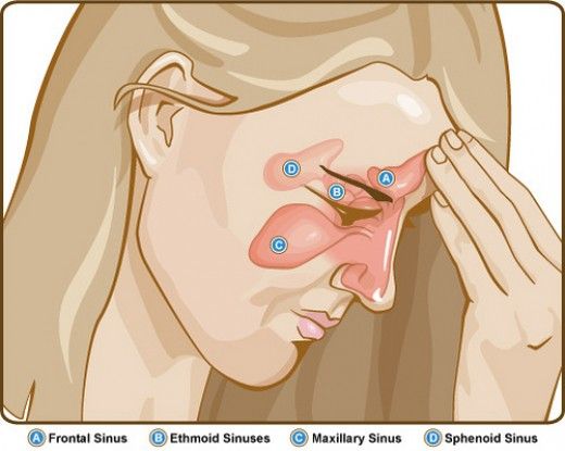 Sinus pressure and facial pain Home Remedies For Sinus, Sinus Infection Remedies, Natural Headache, Sinus Pain, Allergy Remedies, Chest Congestion, One Night Stand, Stuffy Nose, Sinus Infection