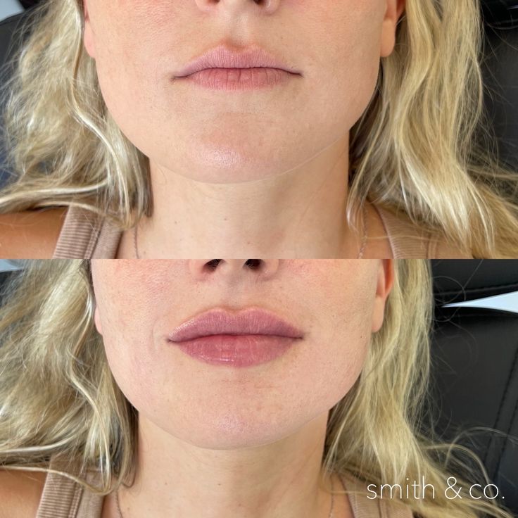 Natural Lip Fillers, Cheek Contouring, Cupids Bow Lips, Thick Lips, Juvederm Voluma, Lip Lift, Heart Shaped Lips, Lips Inspiration, Botox Lips