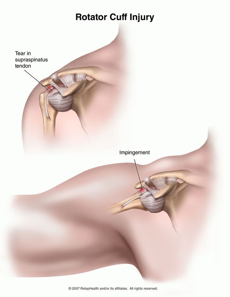 Punkty Spustowe, Shoulder Anatomy, Rotator Cuff Surgery, Shoulder Rehab, Rotator Cuff Injury, Shoulder Pain Relief, Shoulder Surgery, Human Body Anatomy, Muscle Anatomy