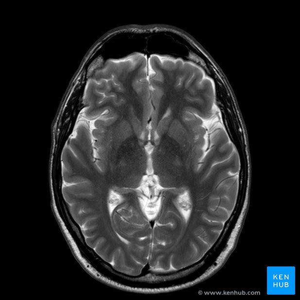 Mri Study Guide, Brain Mri, Brain Lobes, Caudate Nucleus, Ray Aesthetic, Mri Brain, Basal Ganglia, Occipital Lobe, Brain Surgeon