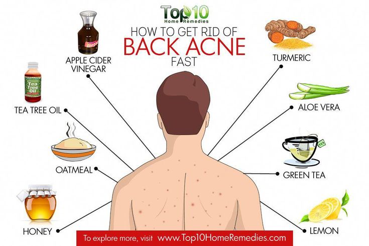 A Small Tattoo, Back Acne Remedies, Back Acne, Green Tea Lemon, Forehead Acne, Top 10 Home Remedies, Natural Hair Mask, How To Grow Eyebrows, Tattoos For Black Skin