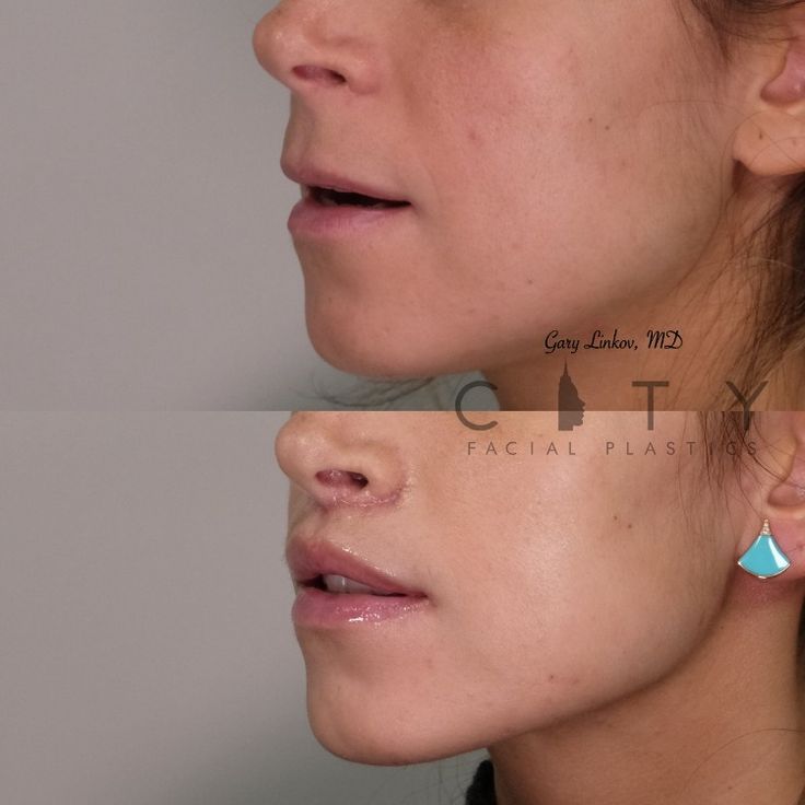 AMAZING RESULTS ALERT 🚨: here is a beautiful Elelyft™️ lip lift 👄 patient just 3 weeks post-surgery healing impeccably well. It one of my FAVORITE surgeries. 
⁠⠀⁠
This lovely patient, who flew in from another country, desired a much shorter philtrum and a fuller upper red lip. She is extremely delighted with her early results and so am I 🕺.  I am humbled at how far patients are willing to travel to see me 😍. Lip Plastic Surgery, Upper Lip Lift, Jaw Reduction Surgery, Jawline Goals, Facial Symmetry, Lip Surgery, Lip Lift, Plastic Surgery Fail, Rhinoplasty Nose Jobs