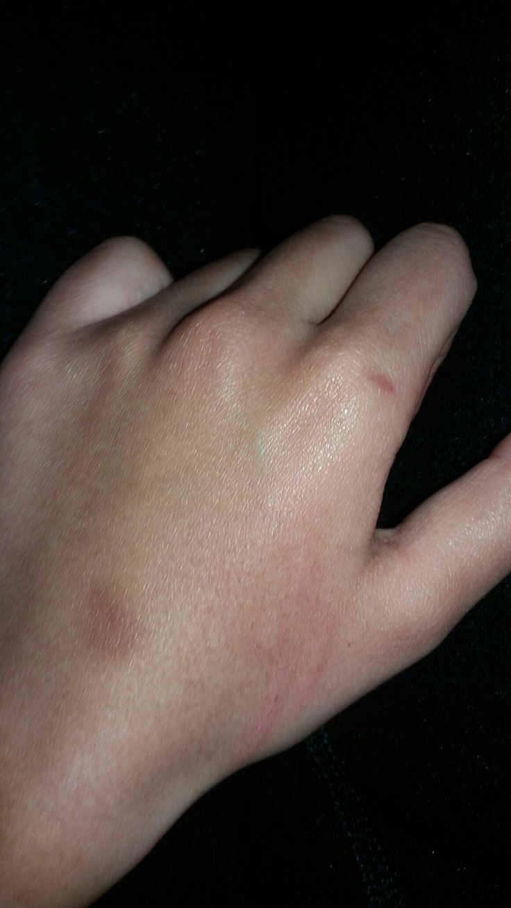 a person's hand with red spots on the left side of their thumb and fingers