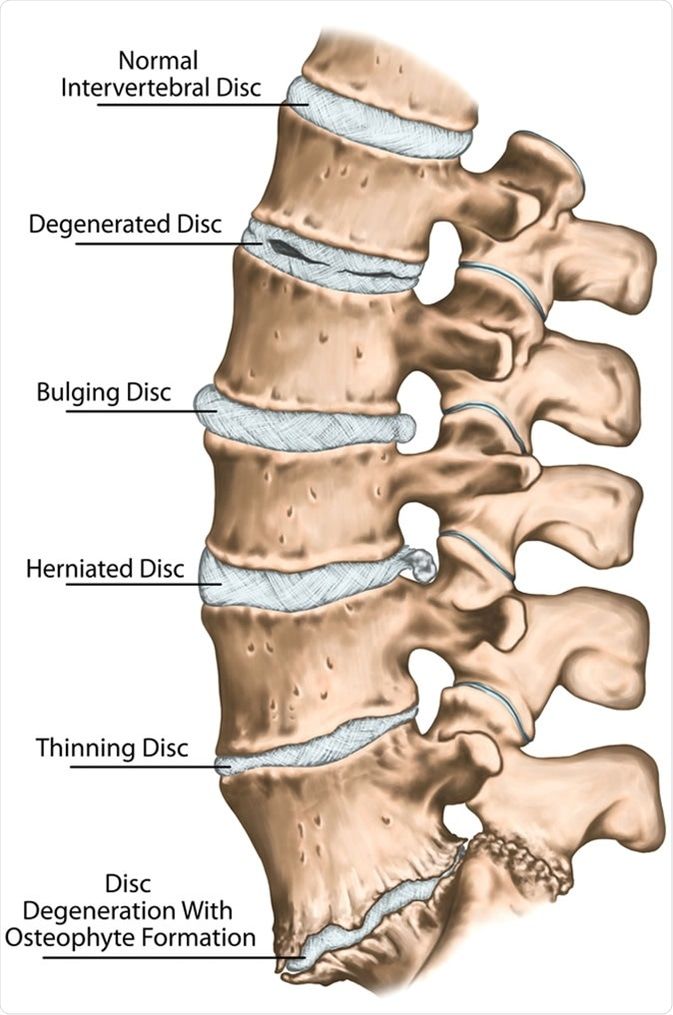 Spinal Degeneration, Lumbar Disc, Intervertebral Disc, Bulging Disc, Disk Herniation, Spinal Nerve, Degenerative Disease, Spine Health, Human Skeleton