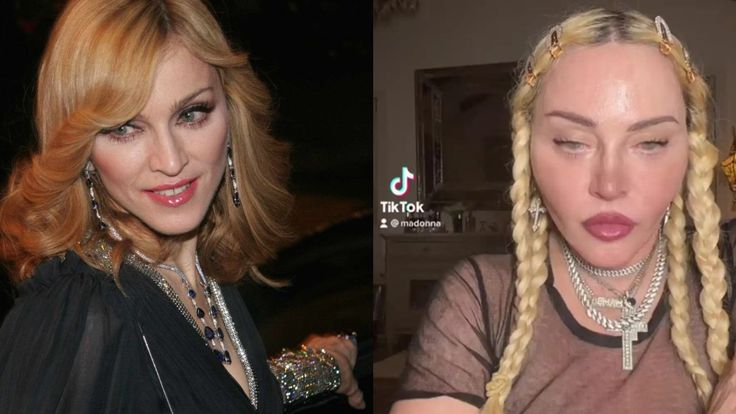 Madonna is more associated with plastic surgery as of 2022 than with her contribution to the music industry, especially on Reddit. Loads of people who are not Madonna have talked about what kind of plastic surgery she has done, whereas the musician herself does not care for discussing it. People believe that the singer has gotten facelifts, fillers on cheeks and lips, butt implants, collagen implants, and Botox. Since 2021, Madonna’s plastic surgery has become fodder for gossip on Reddit. Madonna Before And After Surgery, Madonna Plastic Surgeries, Fluer De Lis, Celebrity Plastic Surgery, The Music Industry, After Surgery, Forever Young, Music Industry, Plastic Surgery