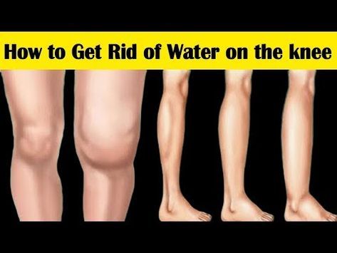 Inflammation In The Knee, Fluid In Knee Remedy, Water On The Knee Remedies, Knee Popping Remedies, Fatty Knees Get Rid Of, Swollen Knee Causes, Bursitis Knee Remedies, Knee Swelling Remedy, Stiff Knees Remedies