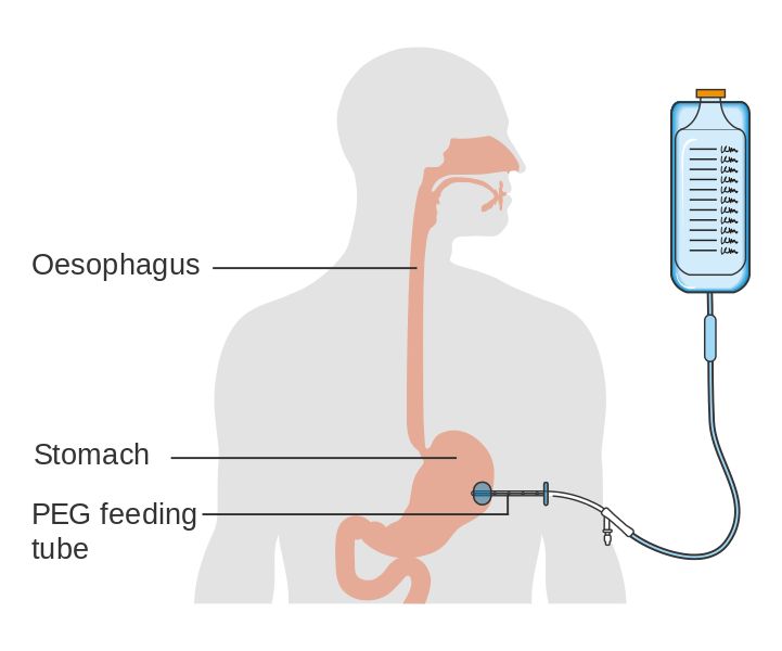 Difference Between TPN and Tube Feeding Check more at https://in4arts.com/difference-between-tpn-and-tube-feeding.html Peg Tube Feeding, Refeeding Syndrome, Gastrostomy Tube, Aspiration Pneumonia, Peg Tube, Tube Feeding, Psychological Effects, Feeding Tube, Mobility Aids