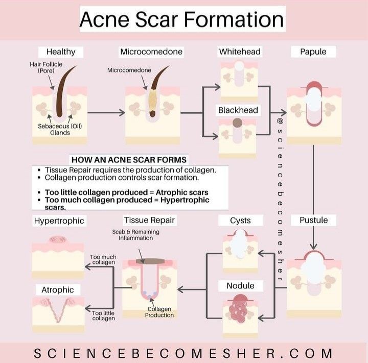 Acne Meaning, Pimple Causes, Skin Consultation, Glow Bar, Skin Cycling, Esthetician Inspiration, Hypertrophic Scars, Skin Facts, Skin Care Ingredients