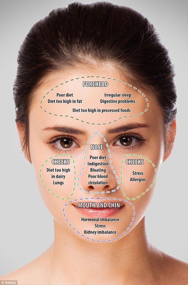 Doctor of traditional Chinese medicine and wellbeing expert, John Tsagaris, believes that breakouts on varioys areas of the face can reflect different problems in your internal health Doterra Acne, Gesicht Mapping, Acne Chart, Face Mapping Acne, Face Mapping, Face Acne, Acne Remedies, Acne Skin, Reflexology