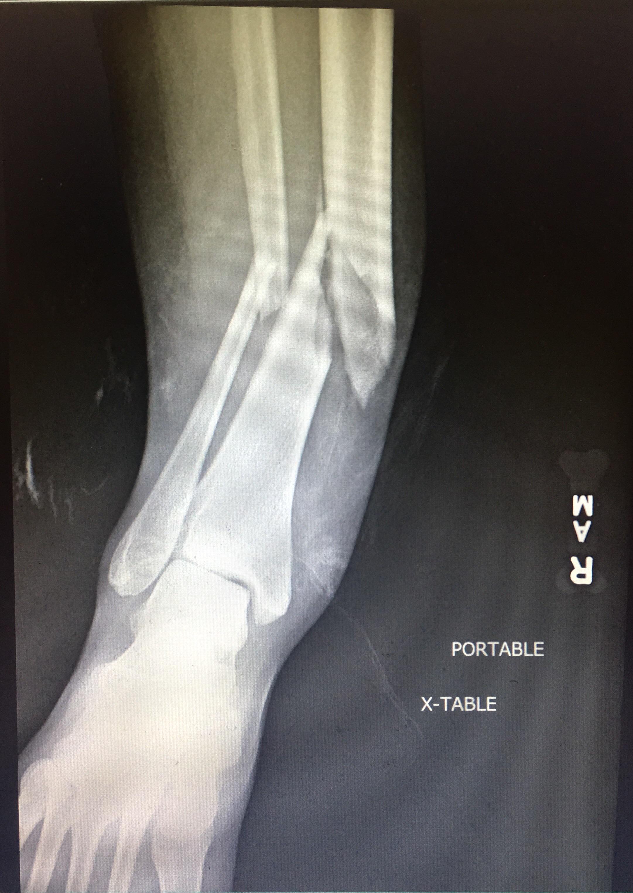 Tibia fracture - mytetechnologies