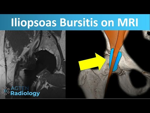 Hip Bursitis MRI