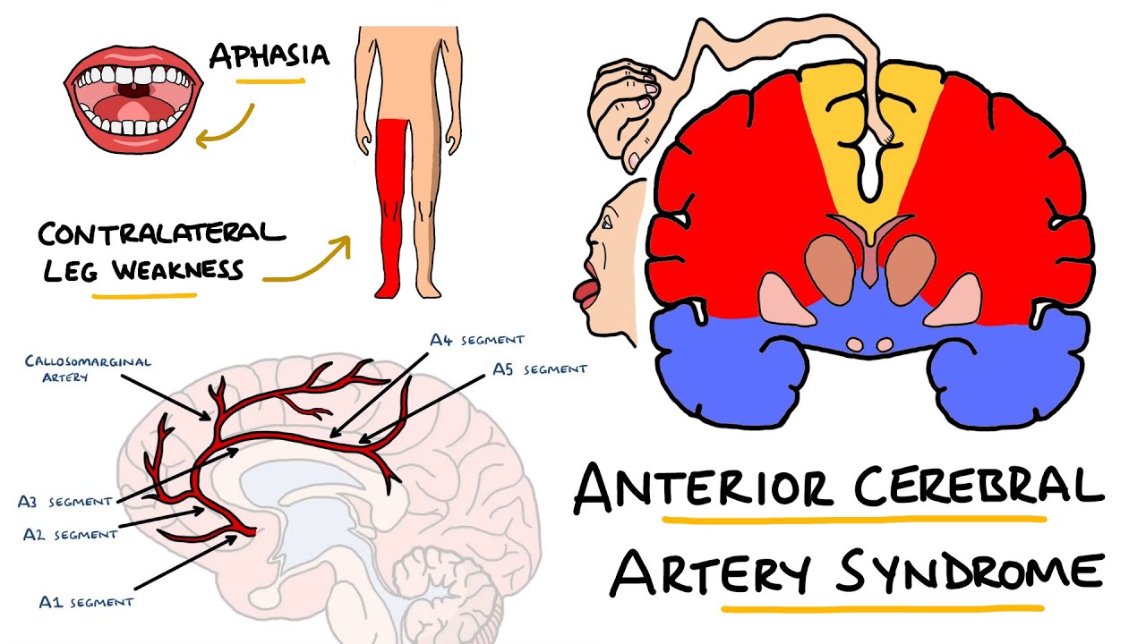 Anterior Cerebral Artery Stroke