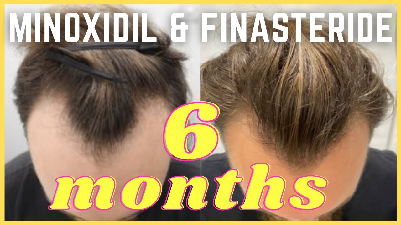 Minoxidil Before And After Photos [2023] Is It Right For, 47% OFF