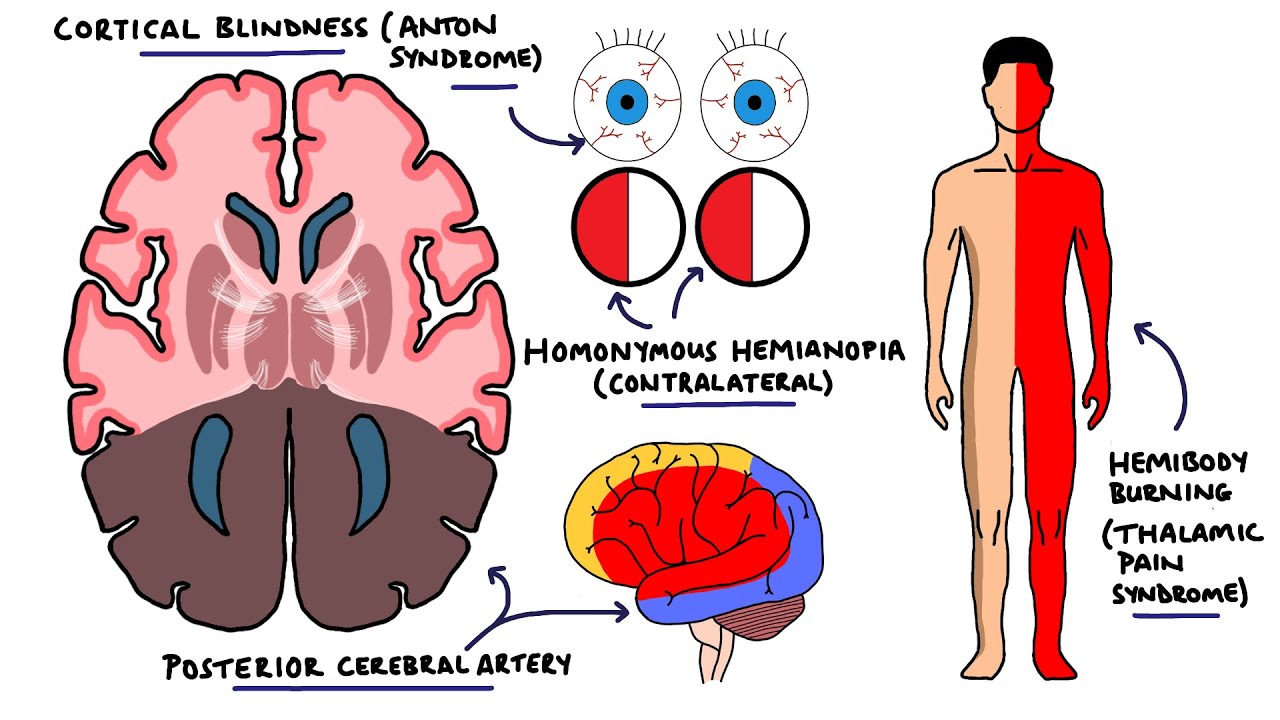 Cerebral Artery Occlusion Pathophysiology - mapasgmaes