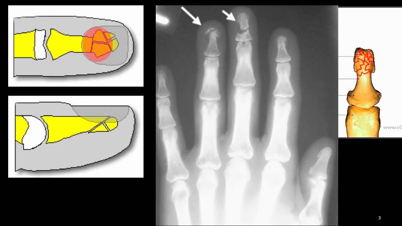 Distal Phalanx Tuft Fracture