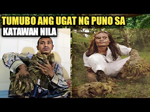 TINUBUAN NG UGAT NG PUNO SA KAMAY AT PAA | DOCUMENTARY PH