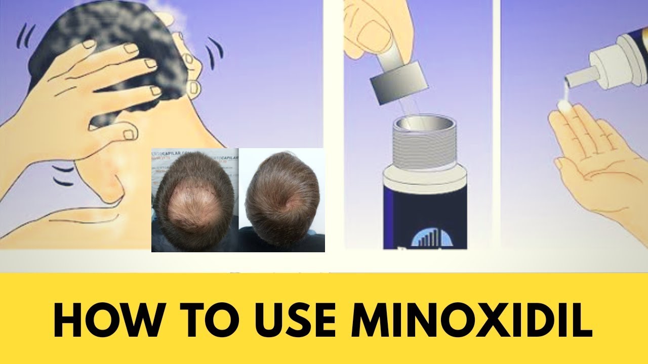 How To Use Minoxidil For Hair Loss at Beth Sharma blog