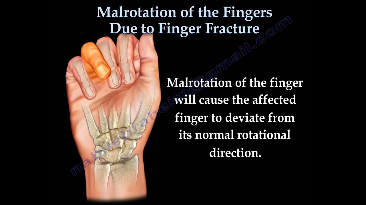 Metacarpal fracture - retiball