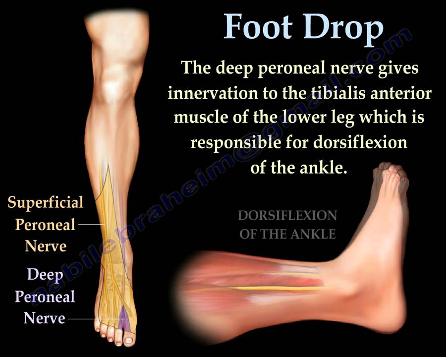 Peroneal Nerve Foot Drop