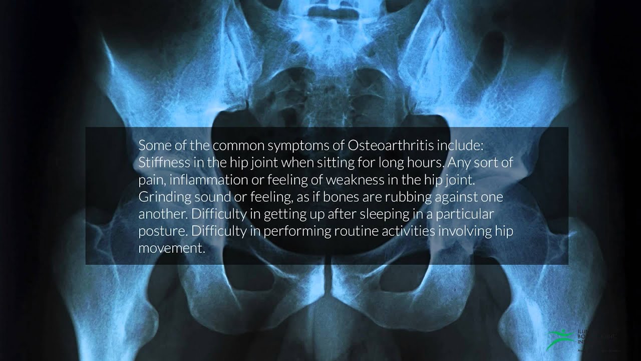 Osteoarthritis Hip Pain Diagnosis Chart