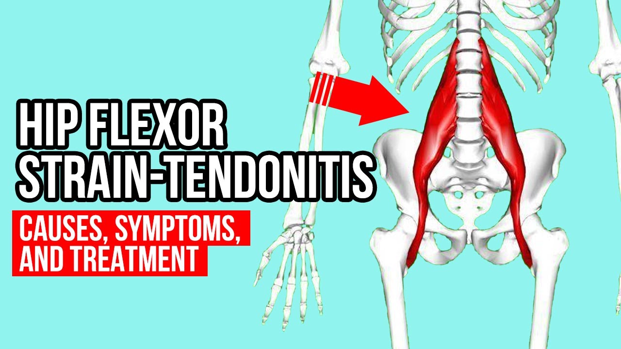 Hip Flexor Tendinitis Vs Hip Osteoarthritis Youtube - vrogue.co