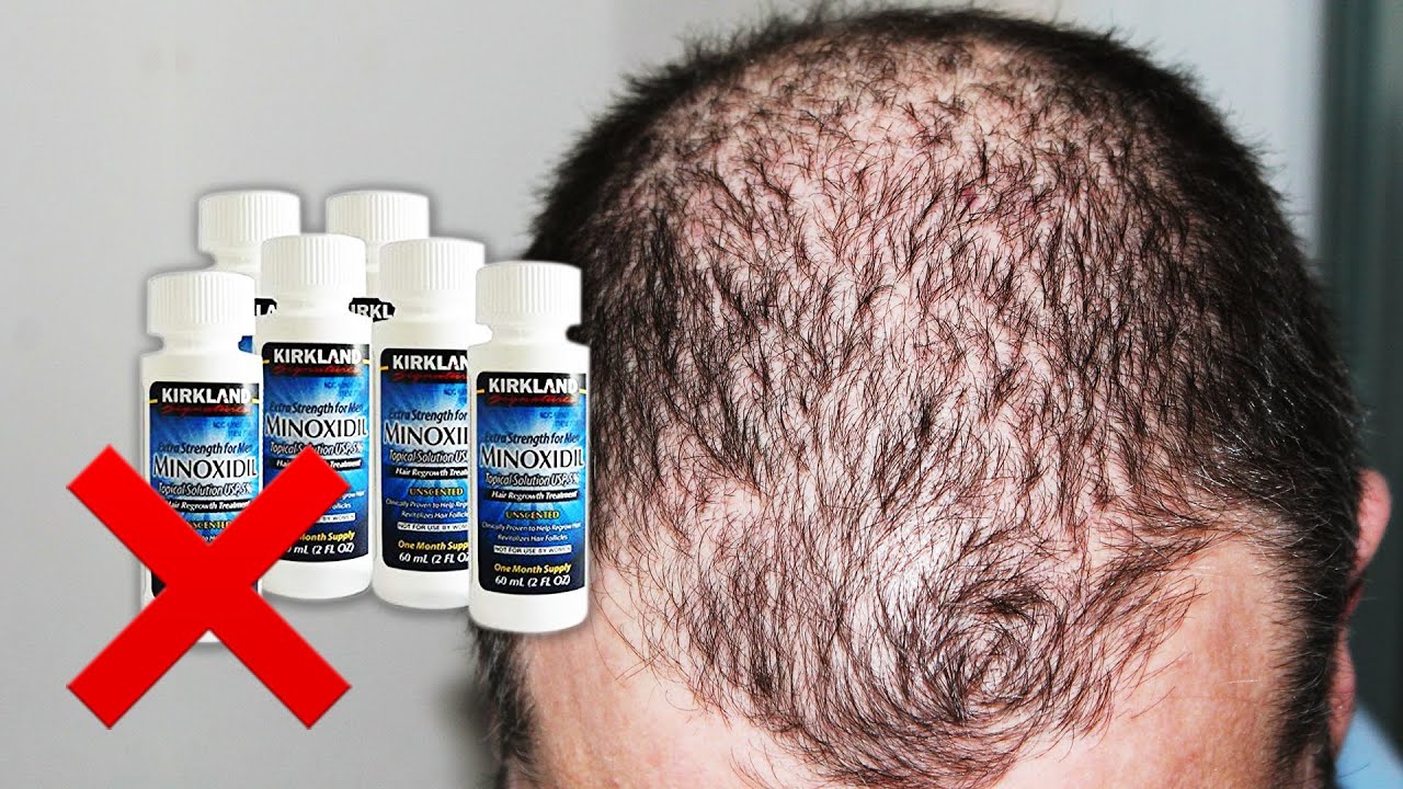 Minoxidil Before And After Men