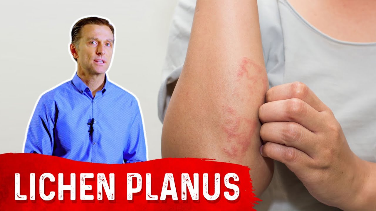 Lichen Planus