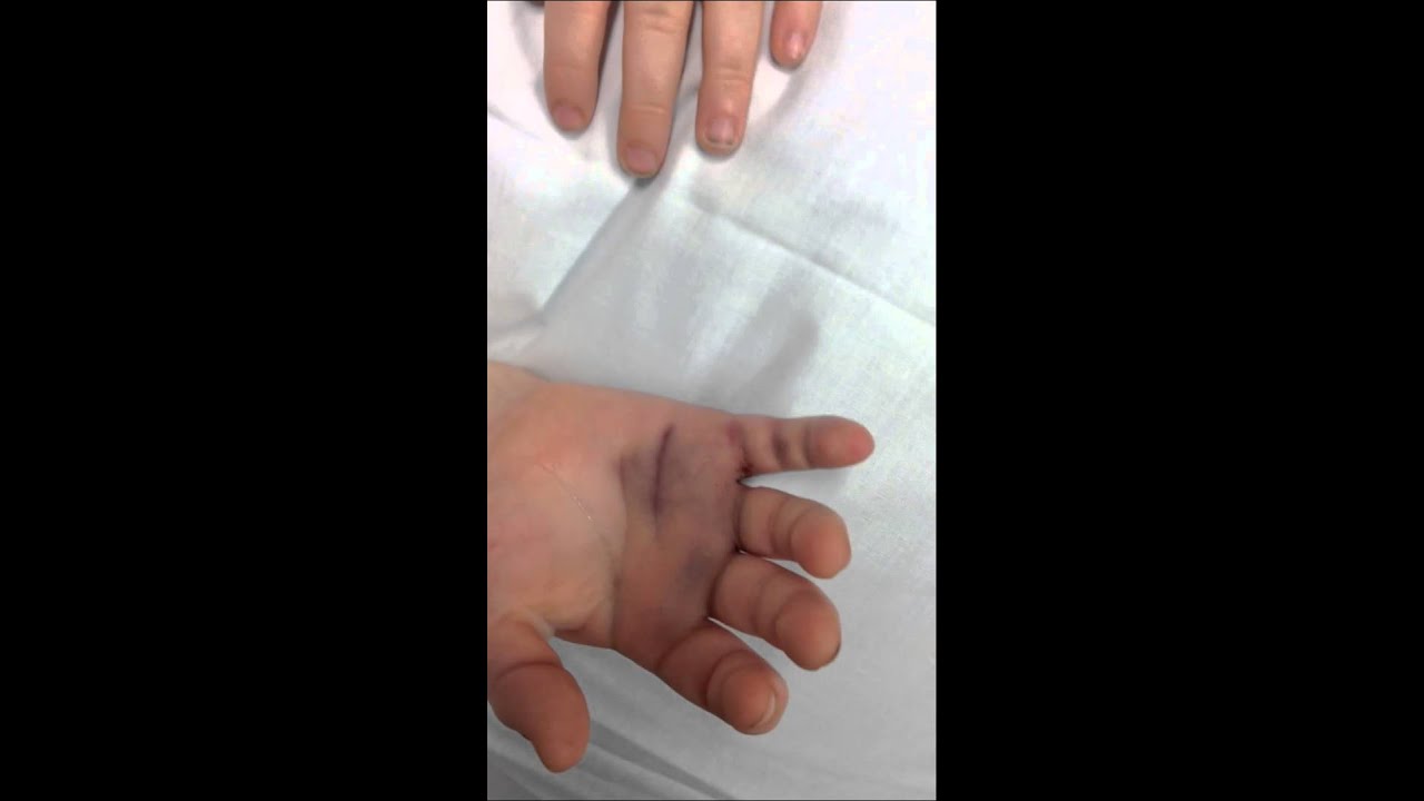 Spiral fracture pinky finger - gloplines