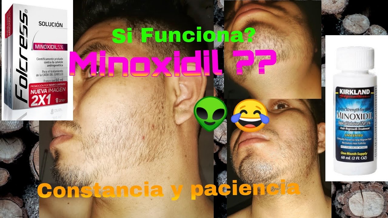 Funciona el Minoxidil funciona para la barba? Constancia y paciencia ...