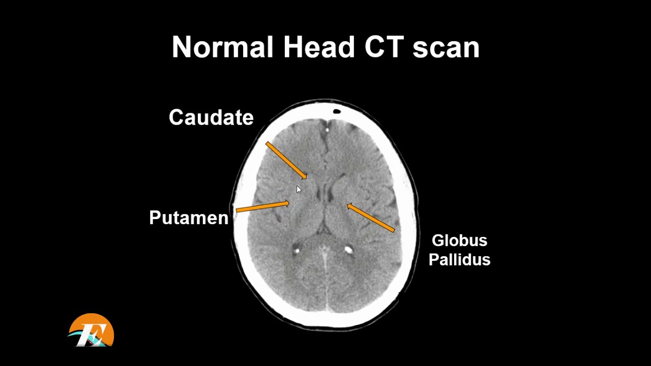 Ct Scan Brain Anatomy Anatomy Of Head Ct Scan Normal The Brain On Ct ...