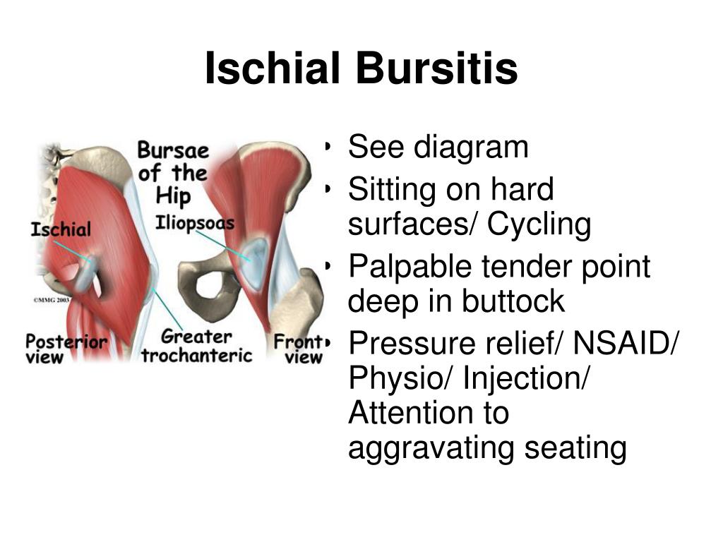 Ischial Tuberosity Bursitis