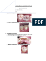 Clasificación de Las Caries Dentales