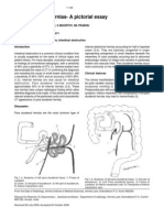 Paraduodenal Hernia