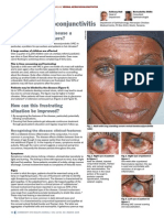 Vernal Keratoconjunctivitis: Why Is Allergic Eye Disease A Problem For Eye Workers?